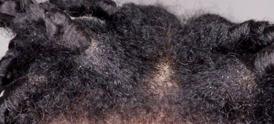 How to remove excess oils and dirt build up to promote healthy hair while wearing braids. Prevent shedding and breakage during your braid take down.