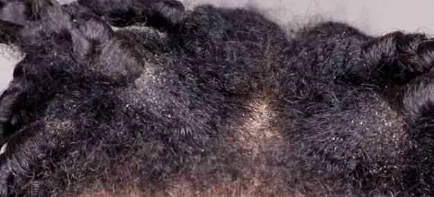 How to remove excess oils and dirt build up to promote healthy hair while wearing braids. Prevent shedding and breakage during your braid take down.